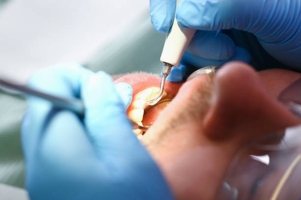 Best Emergency Tooth Extraction in Long Prairie, MN